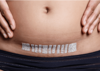 Abdominal myomectomy scar picture