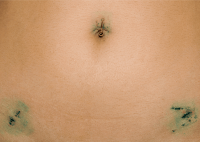Laparoscopic myomectomy scar picture