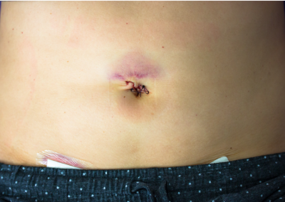 Laparoscopic myomectomy scar picture