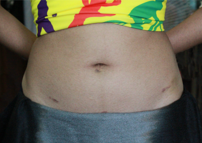 Laparoscopic myomectomy scar picture healed