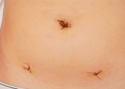 Laparoscopic myomectomy scar picture